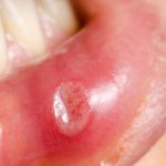 бактериальный стоматит на губе