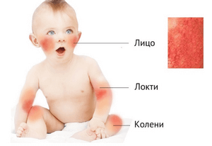 Чесотка у ребенка: симптомы и лечение