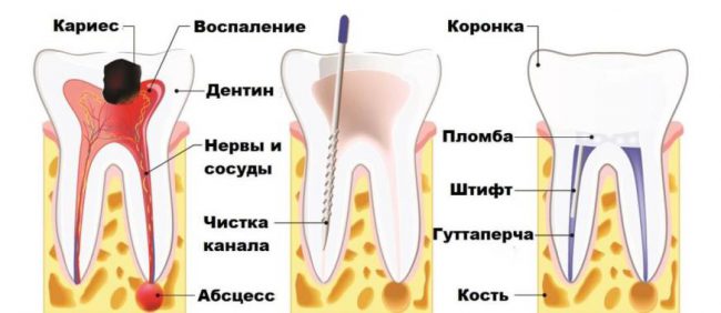 чистка канала зуба