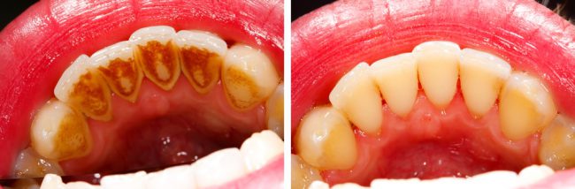 Зубы до и после удаления зубного налёта