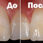 зубы до и после реставрации
