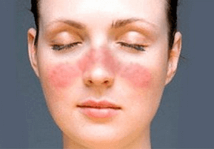 Чем лечить экзему на лице: стадии и симптомы