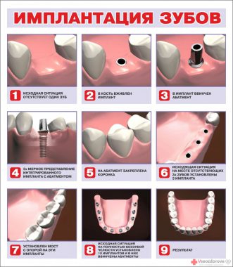 последовательность при имплантации зуба