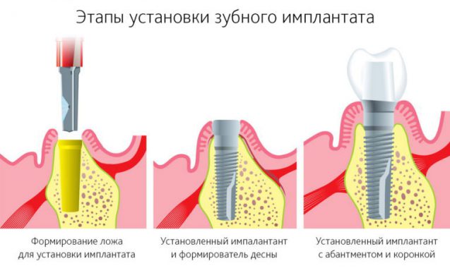 Этапы установки зубного импланта