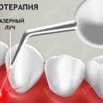 фототерапия в стоматологии