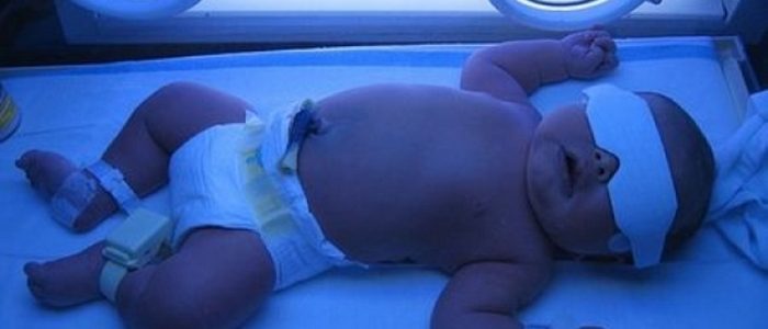 Фототерапия для новорожденных при желтухе