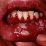 общирное воспаление нижней губы