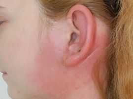 Мокнет за ухом: причины, симптомы и методы лечения