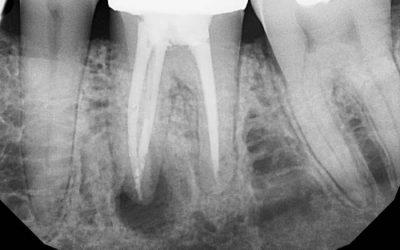 ренген гранулемы зуба