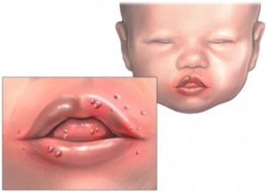 проявления стоматита у новорождённого
