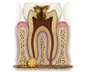 гранулема зуба