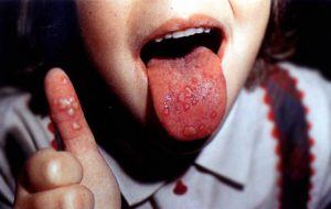 Везикулы на пальце и языке