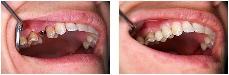 Коронку, установленную на имплант, невозможно визуально отличить от настоящего зуба.