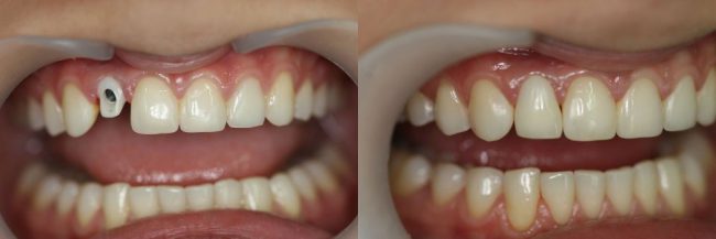 зуб до и после имплантации 