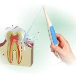 Очищение зубного кармана с помощью ирригатора