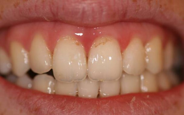 истончение эмали зуба после отбеливания