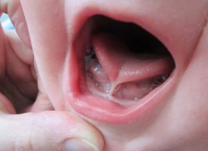 аномальная уздечка языка у малыша