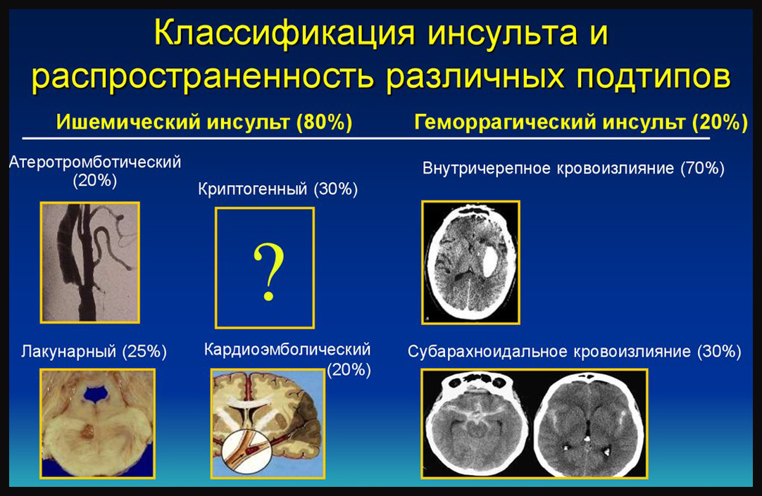 Развернутая классификация инсульта мозга с подтипами