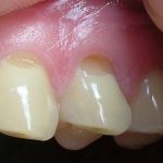 клиновидный дефект на верхних зубах