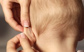 Лопоухие уши – как исправить без операции в домашних условиях