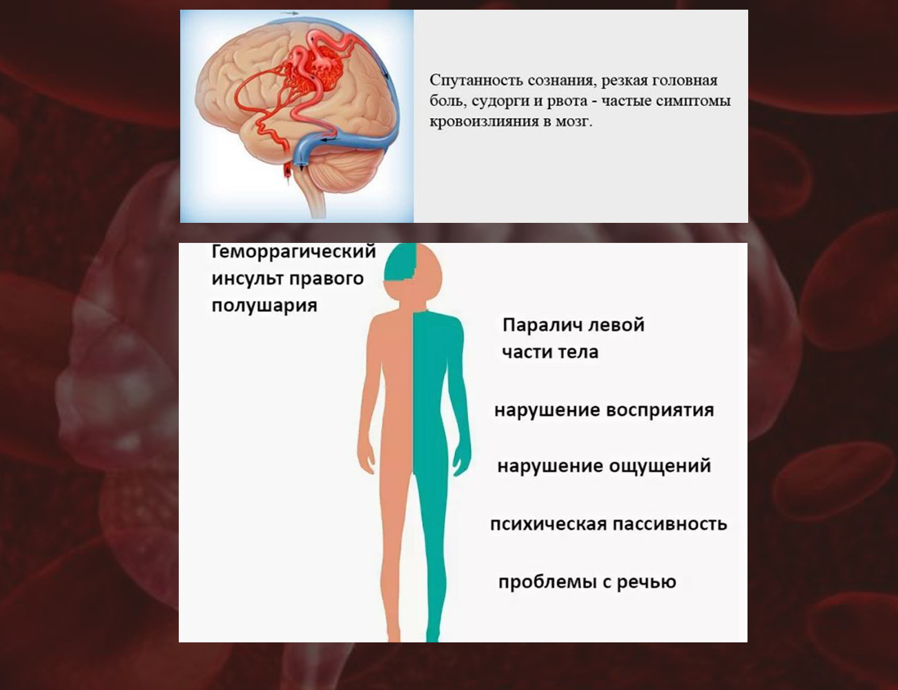 Основные симптомы кровоизлияния в мозг