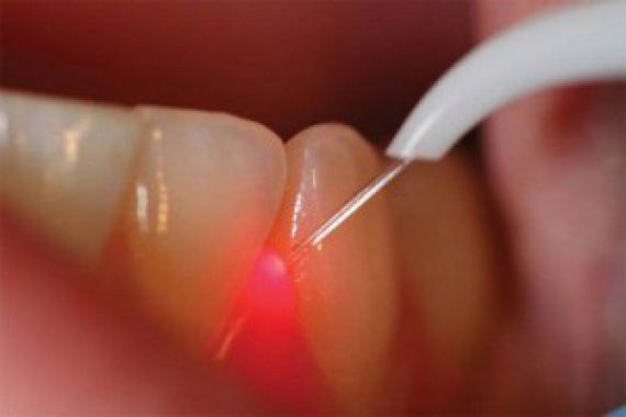лазеротерапия в стоматологии