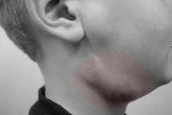 Воспаление лимфоузлов на шее: причины и лечение
