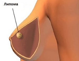 Липома в груди: удалять или нет, лечение