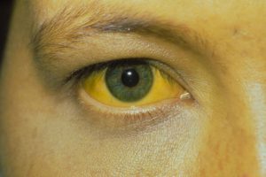 Причины и лечение гемолитической желтухи