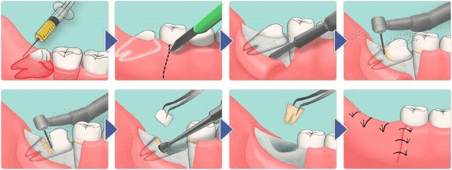 процесс удаления зуба мубрости