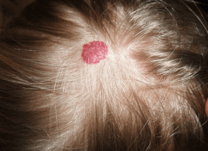 Какая опасность от папилломы на голове: удаление и лечение