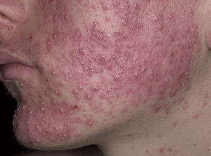 Эффективное лечение себорейного дерматита на лице