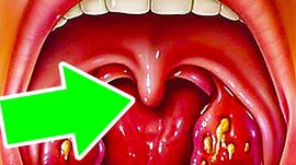 Язычок в горле увеличился и касается корня языка что делать, как лечить
