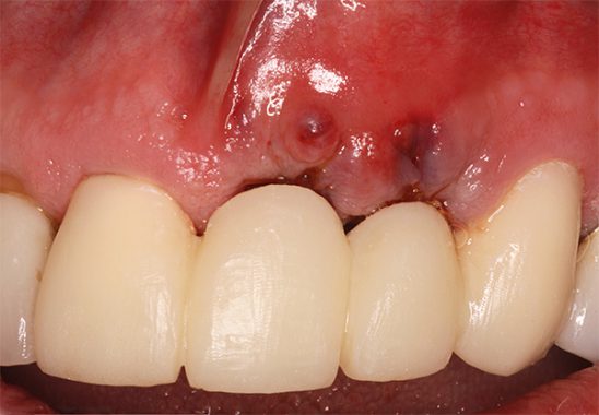отторжение зубного импланта из-за воспаления