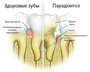 поражённый пародонтозом зуб