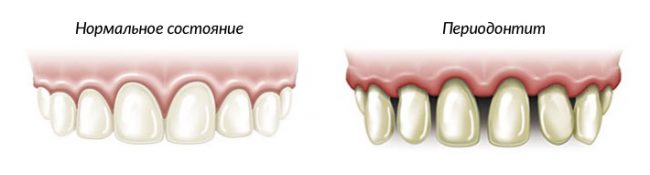 Сравнение нормального состояния зубов и периодонтита