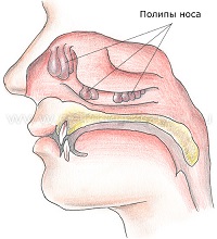 Симптомы полипов в носу