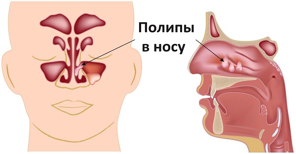 Полипы в носу - лечение без операции