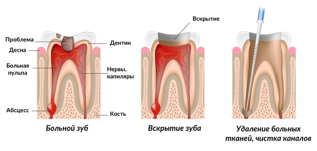 депульпирование зуба