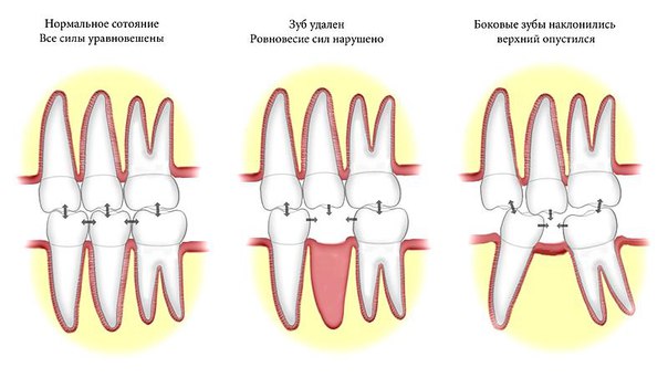 негативные последствия потери зуба