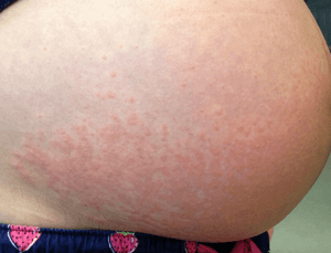 Чем лечить крапивницу во время беременности