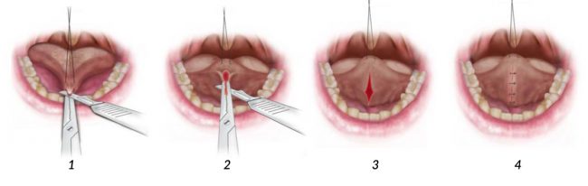 операция по подрезанию уздечки под языком
