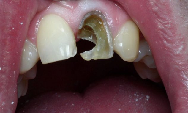 разрушенный зуб