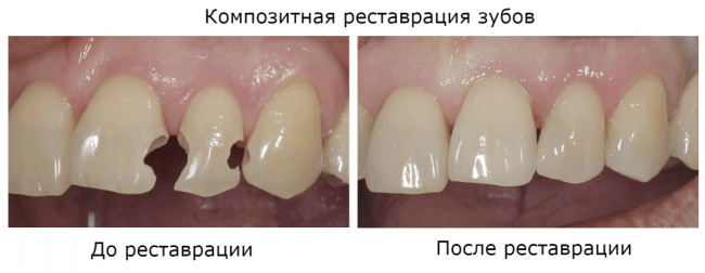 реставрация зубов до и после
