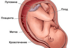 Ретрохориальная гематома при беременности