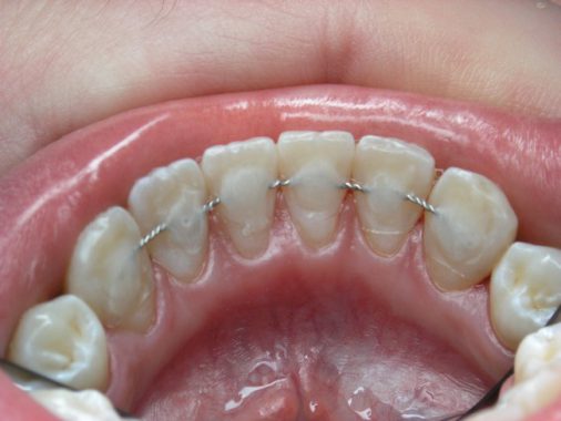шинирование зубов при болезнях пародонта