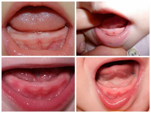 симптомы прорезывания зубов
