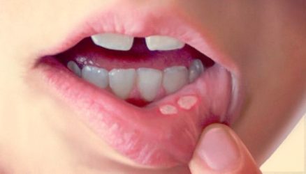 высыпания на внутренней стороне губы
