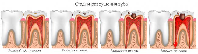 этапы разрушения зуба