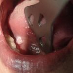 Почему болит язык сбоку и как его вылечить
